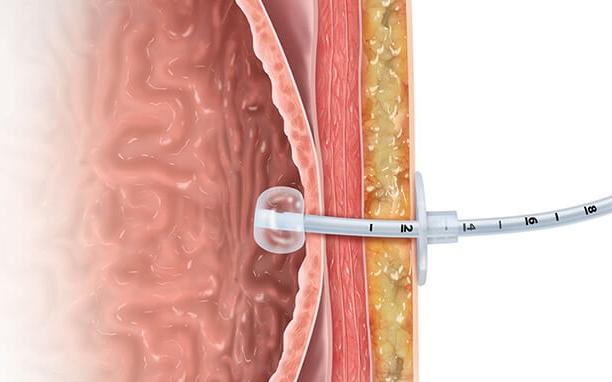 Gastrostomy Tube Placement